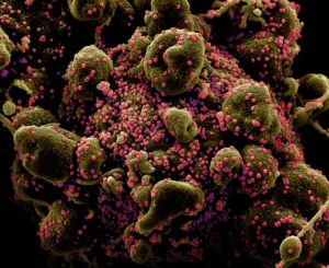 Imagens mostram coronavírus Sars-CoV-2 “matando” célula humana