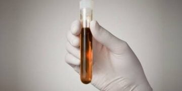 Rabdomiólise: tudo o que você precisa saber sobre a doença da ‘urina preta’
