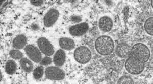 Leia mais sobre o artigo Ministério da Saúde confirma primeira morte por varíola dos macacos no país